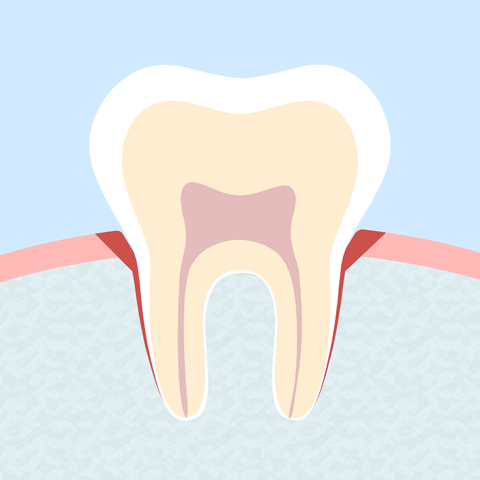 Parodontose als Zahnfleisch-Erkrankung